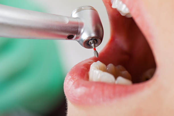 Best Knocked-Out Tooth (Avulsed Tooth) Treatment in Frisco City, AL